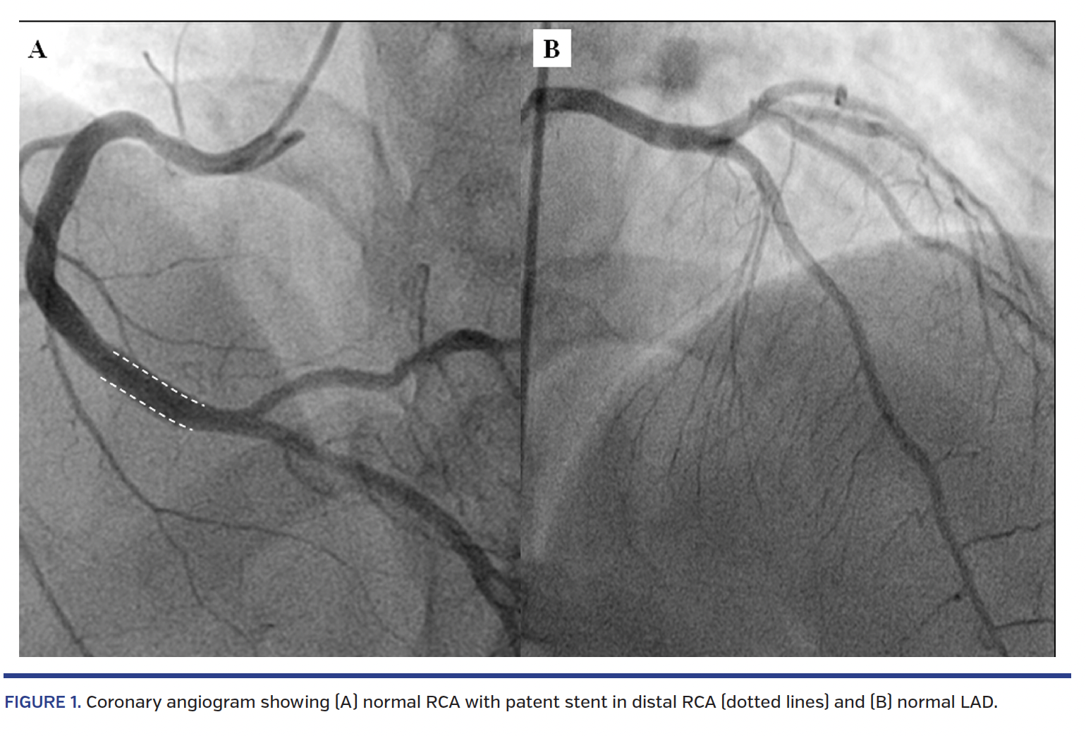 FIGURE 1. Coronary angiogram showing (A) normal RCA with patent stent in distal RCA (dotted lines) and (B) normal LAD.