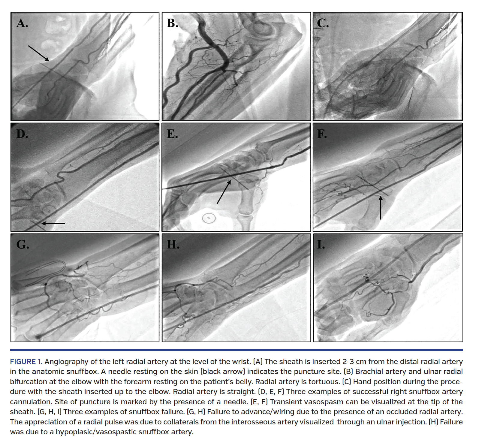 Angiography of the left radial artery at the level of the wrist. (A) The sheath is inserted 2-3 cm from the distal radial artery in the anatomic snuffbox. A needle resting on the skin (black arrow) indicates the puncture site.
