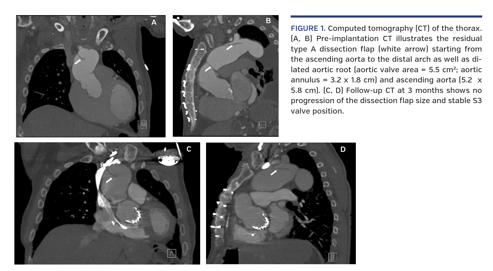 FIGURE 1. Computed tomography (CT) of the thorax.