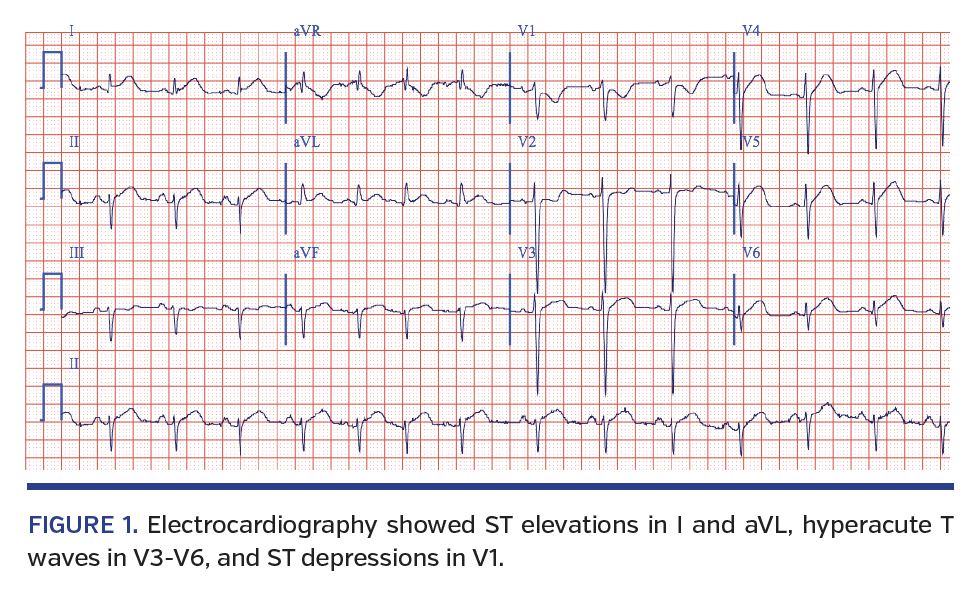 FIGURE 1. Electrocardiography showed ST elevations in I and aVL, hyperacute T waves in V3-V6, and ST depressions in V1. FIGURE 2. Angiography revealed dynamic compression of the LAD during systole (A) that disappeared during diastole (B), consistent with severe myocardial bridging. A B From 1the Department of Internal Medicine, Beth Israel Deaconess Medical Center, Boston, Massachusetts; and 2Division of Cardiology, Department of Internal Medicine, Beth Israel Deaconess Medical Center, Boston, Massachusetts. Disclosure: The authors have completed and returned the ICMJE Form for Disclosure of Potential Conflicts of Interest. The authors report no conflicts of interest regarding the content herein. Manuscript accepted March 2, 2018. Address for correspondence: Meghan York, MD, Beth Israel Deaconess Medical Center, 148 Chestnut Street, Needham, MA 02492. Email: myork2@bidmc.harvard.edu A 62-year-old woman with pancreatic