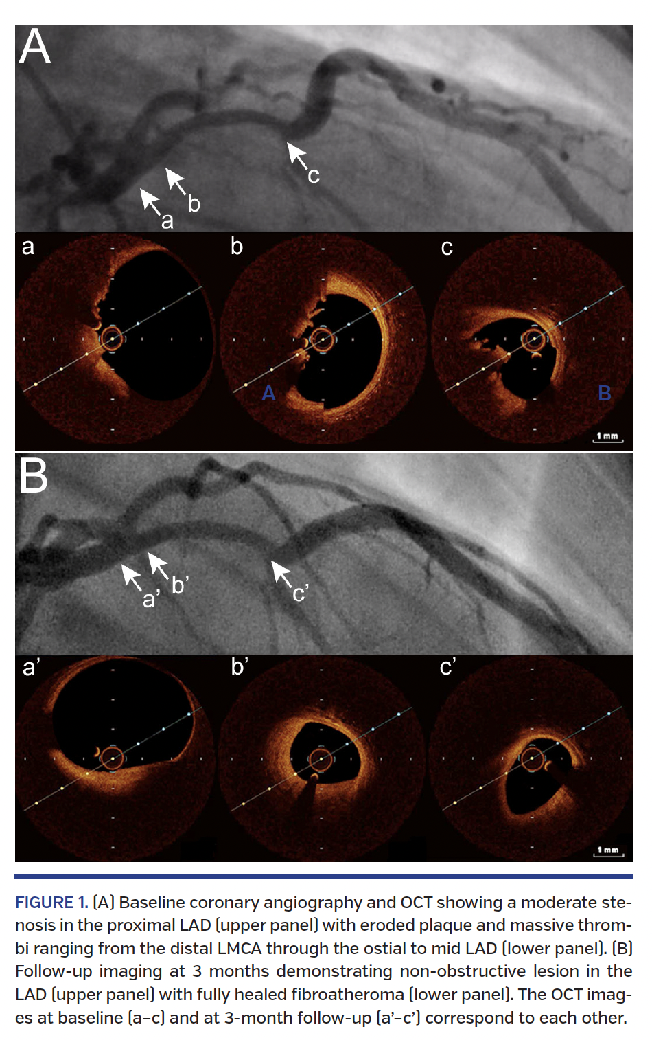 FIGURE 1. (A) Baseline coronary angiography and OCT showing a moderate stenosis in the proximal LAD (upper panel) with eroded plaque and massive thrombi ranging from the distal LMCA through the ostial to mid LAD (lower panel).
