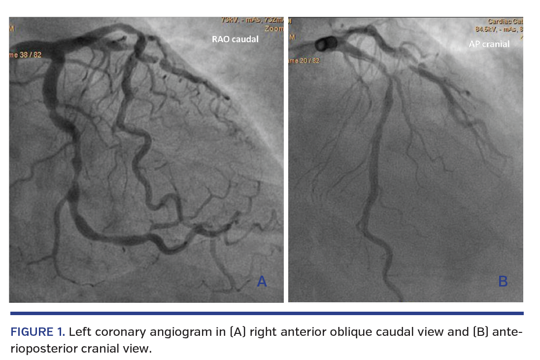 FIGURE 1. Left coronary angiogram in (A) right anterior oblique caudal view and (B) anterioposterior cranial view.