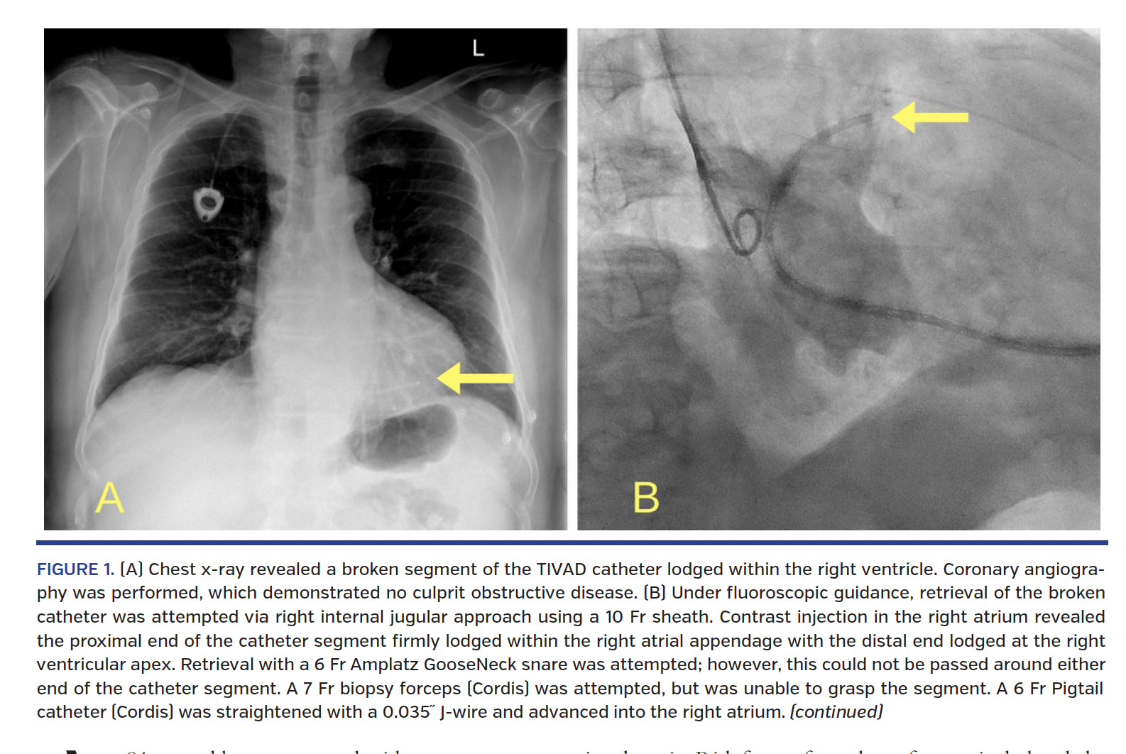 FIGURE 1. (A) Chest x-ray revealed a broken segment of the TIVAD catheter lodged within the right ventricle.