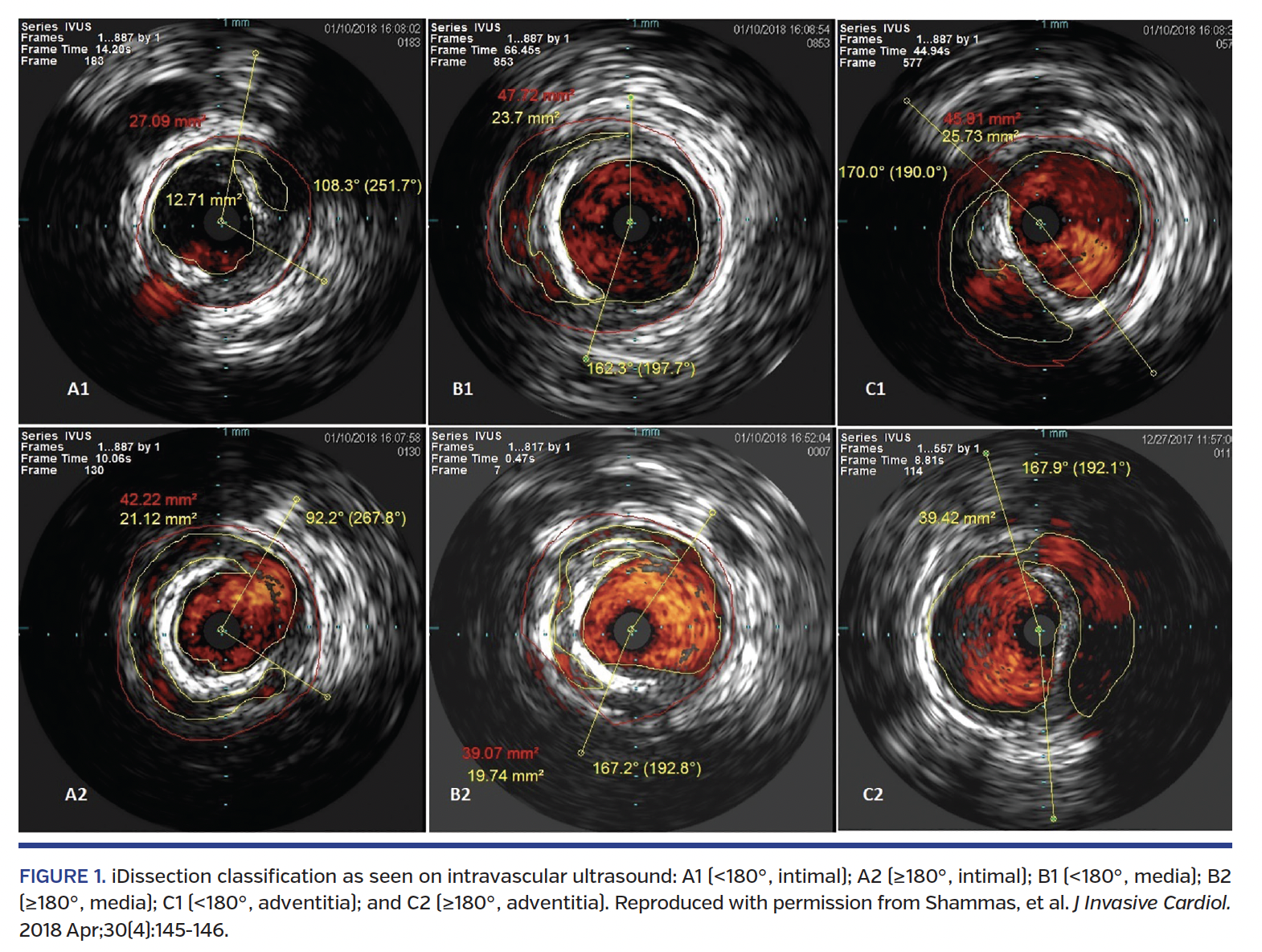 FIGURE 1. iDissection classification as seen on intravascular ultrasound: A1 (<180 , intimal); A2 (≥180 , intimal); B1 (<180 , media); B2 (≥180 , media); C1 (<180 , adventitia); and C2 (≥180 , adventitia). Reproduced with permission from Shammas, et al. J Invasive Cardiol. 2018 Apr;30(4):145-146.