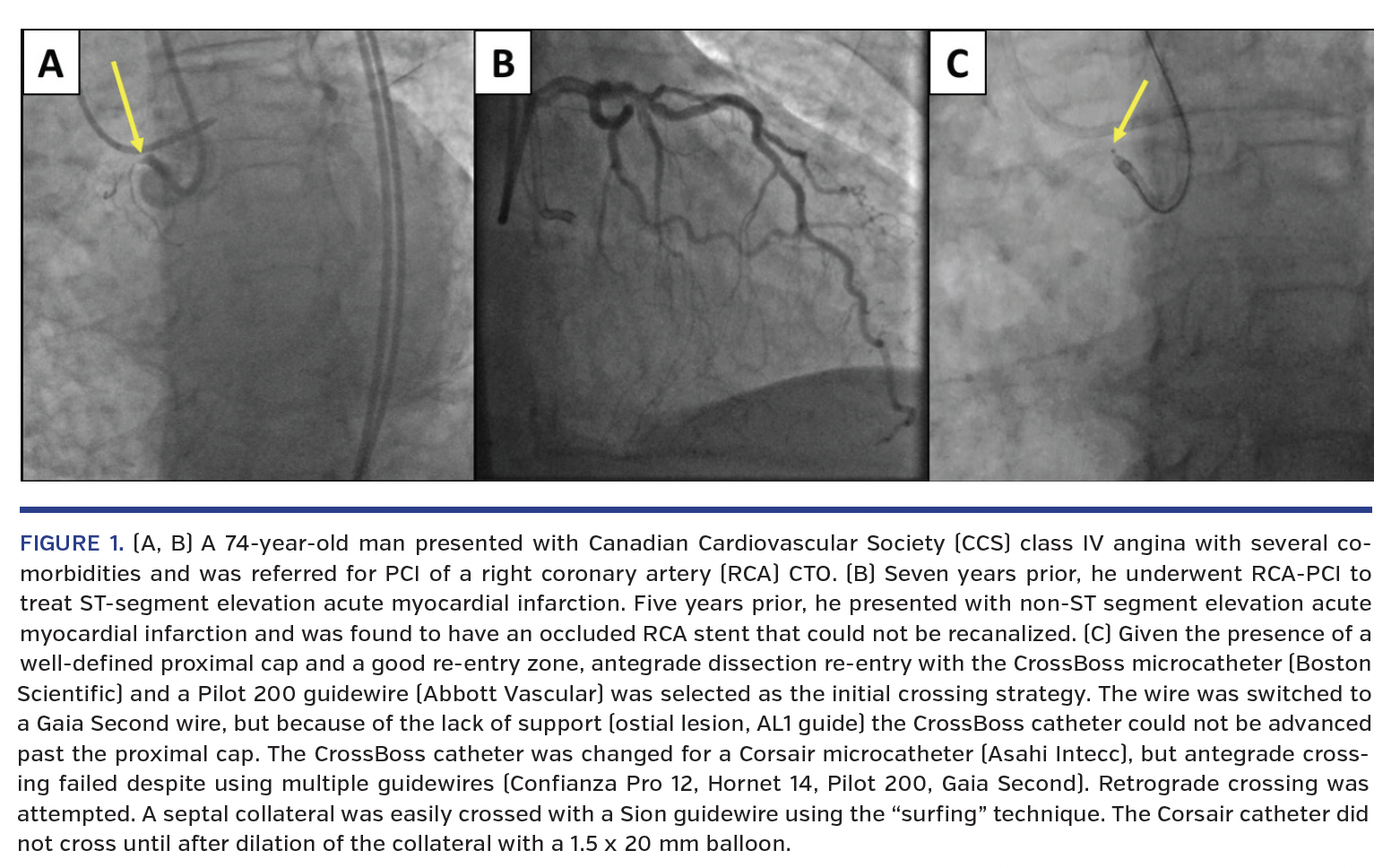 74-year-old man presented with Canadian Cardiovascular Society (CCS) class IV angina
