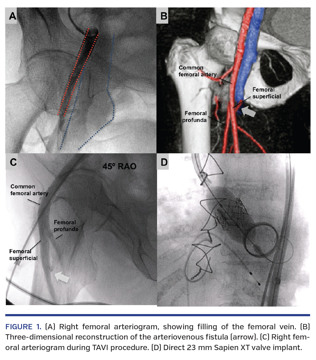 FIGURE 1. (A) Right femoral arteriogram, showing filling of the femoral vein. (B) Three-dimensional reconstruction of the arteriovenous fistula (arrow). (C) Right femoral arteriogram during TAVI procedure. (D) Direct 23 mm Sapien XT valve implant.