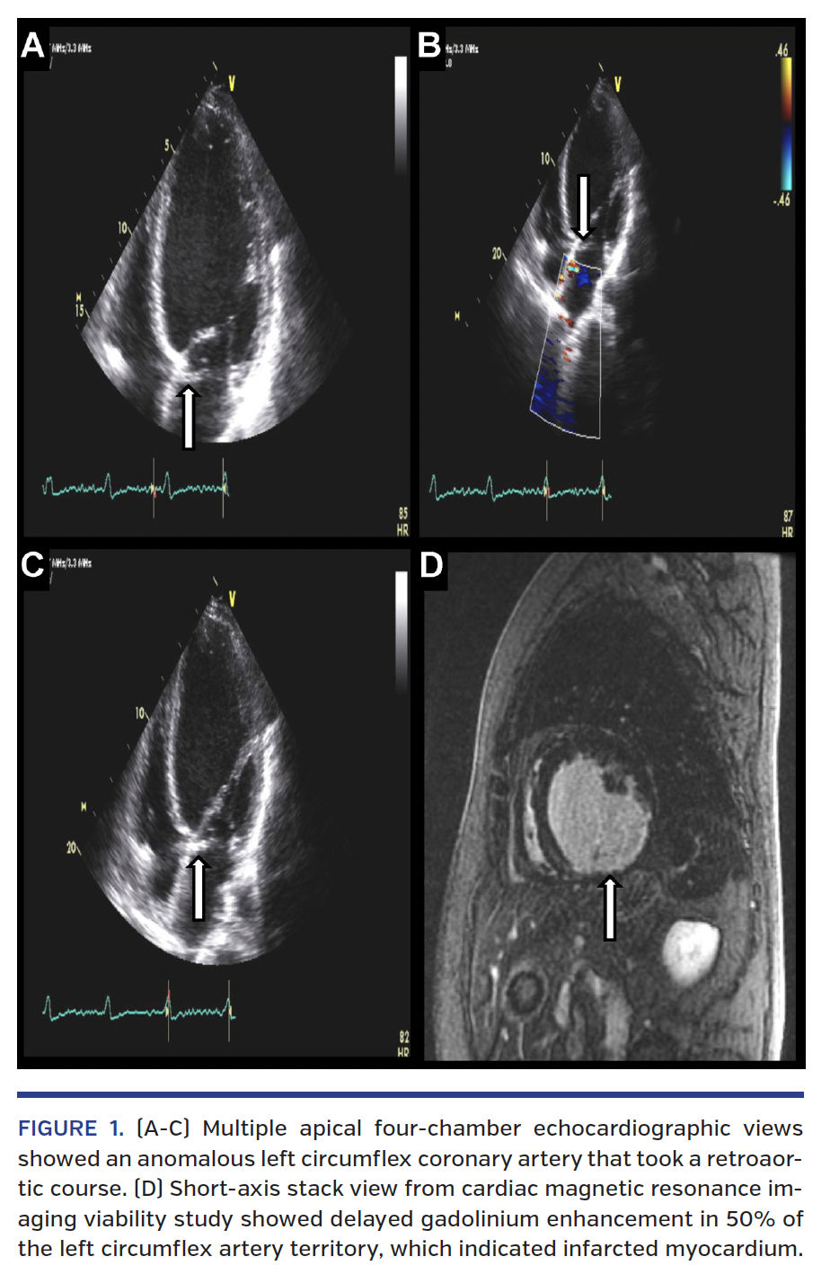 FIGURE 1. (A-C) Multiple apical four-chamber echocardiographic views showed an anomalous left circumflex coronary artery that took a retroaortic course. (
