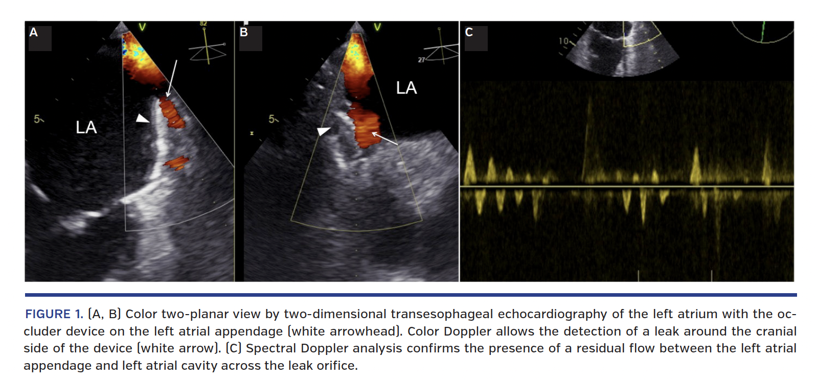 Color two-planar view by two-dimensional transesophageal echocardiography of the left atrium with the occluder device on the left atrial appendage