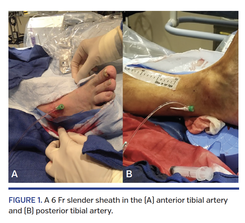 IGURE 1. A 6 Fr slender sheath in the (A) anterior tibial artery and (B) posterior tibial artery.