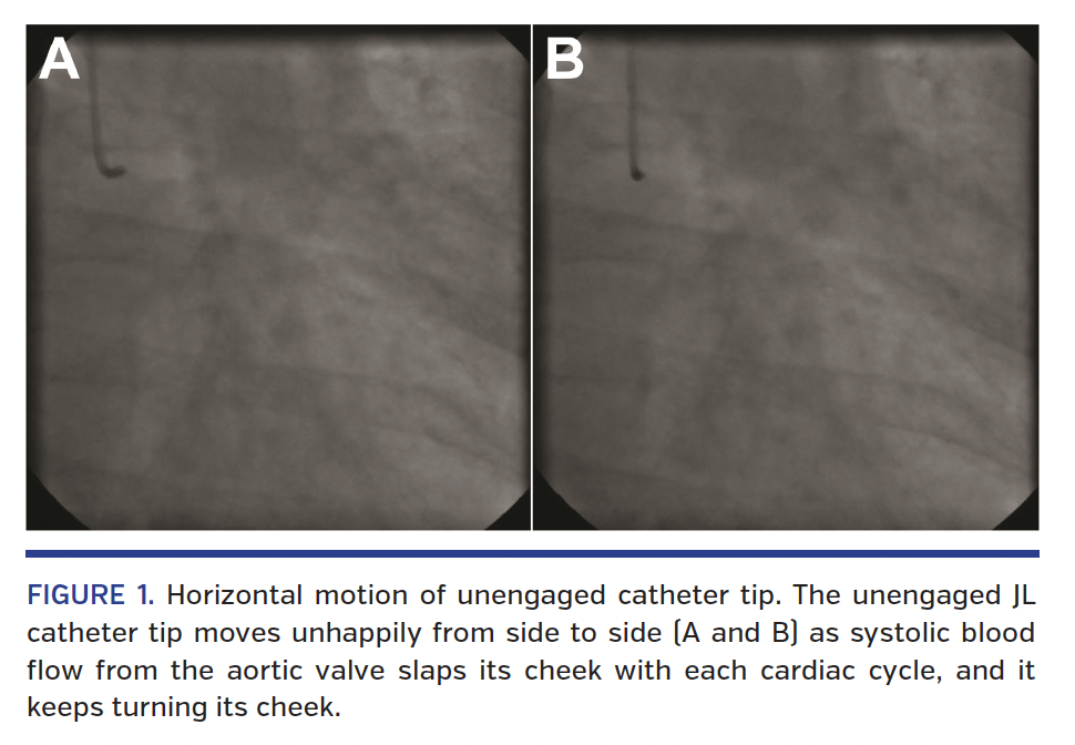 FIGURE 1. Horizontal motion of unengaged catheter tip. The unengaged JL catheter tip moves unhappily from side to side (A and B) as systolic blood flow from the aortic valve slaps its cheek with each cardiac cycle, and it keeps turning its cheek.