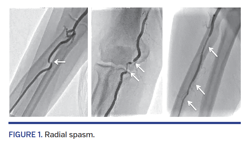 FIGURE 1. Radial spasm.