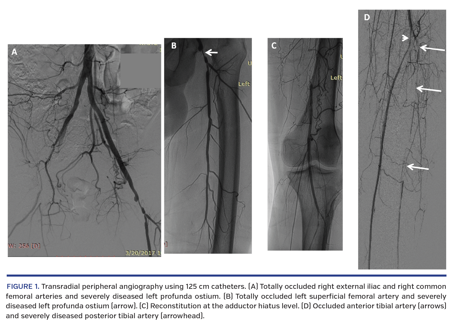 Transradial peripheral angiography using 125 cm catheters. 
