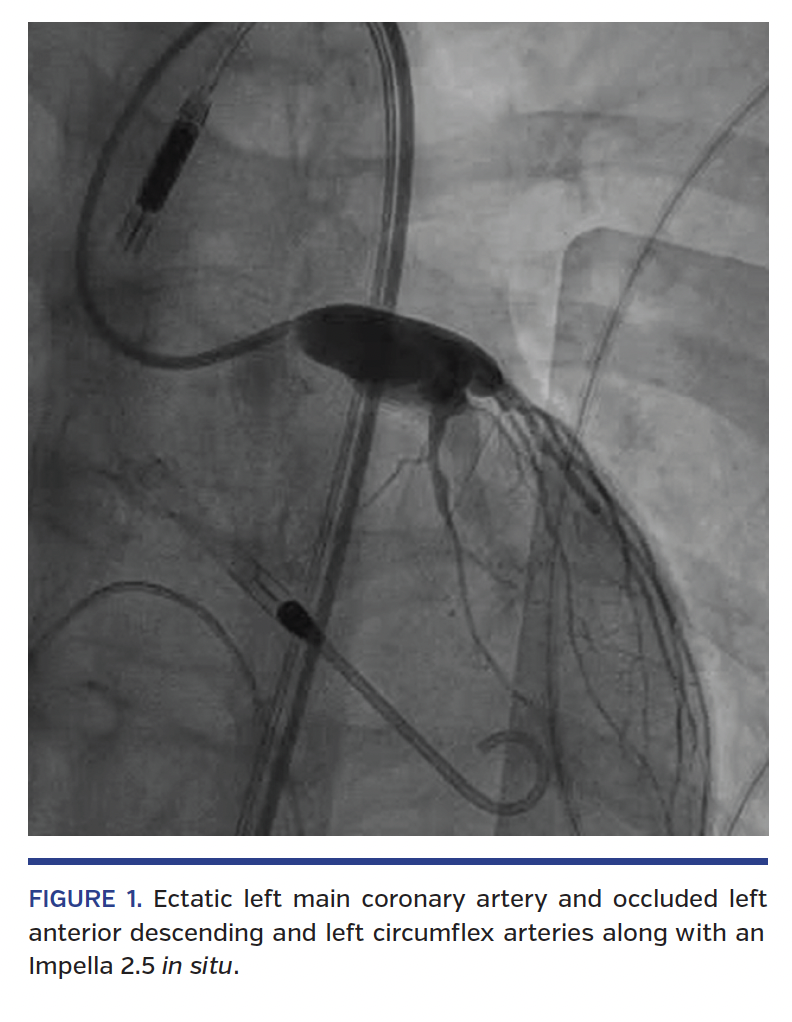FIGURE 1. Ectatic left main coronary artery and occluded left anterior descending and left circumflex arteries along with an Impella 2.5 in situ.