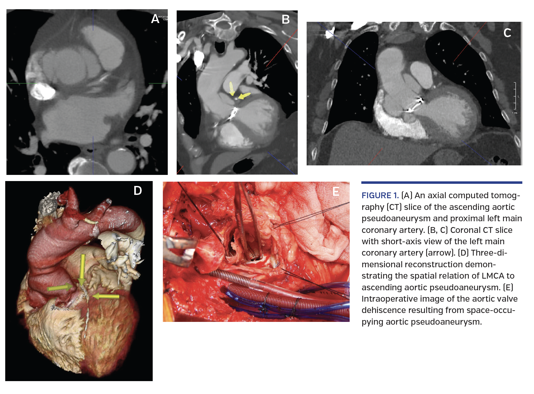 FIGURE 1. (A) An axial computed tomography (CT) slice of the ascending aortic pseudoaneurysm and proximal left main coronary artery. (B, C) Coronal CT slice with short-axis view of the left main coronary artery (arrow). (D) Three-dimensional reconstruction demonstrating the spatial relation of LMCA to ascending aortic pseudoaneurysm. (E) Intraoperative image of the aortic valve dehiscence resulting from spac