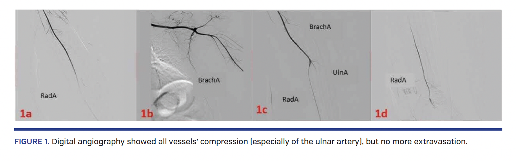 FIGURE 1. Digital angiography showed all vessels’ compression (especially of the ulnar artery), but no more extravasation.