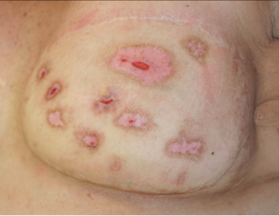 Initial presentation left breast