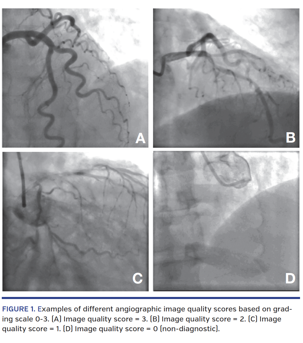 FIGURE 1. Examples of different angiographic image quality scores based on grading scale 0-3. (A) Image quality score = 3. (B) Image quality score = 2. (C) Image quality score = 1. (D) Image quality score = 0 (non-diagnostic).