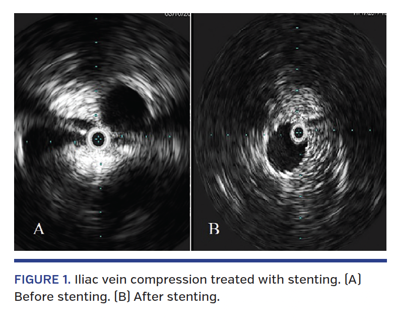 FIGURE 1. Iliac vein compression treated with stenting. (A) Before stenting. (B) After stenting.