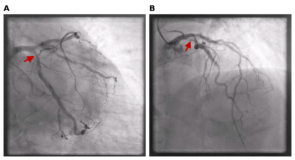 Figure 1. Coronary angiography