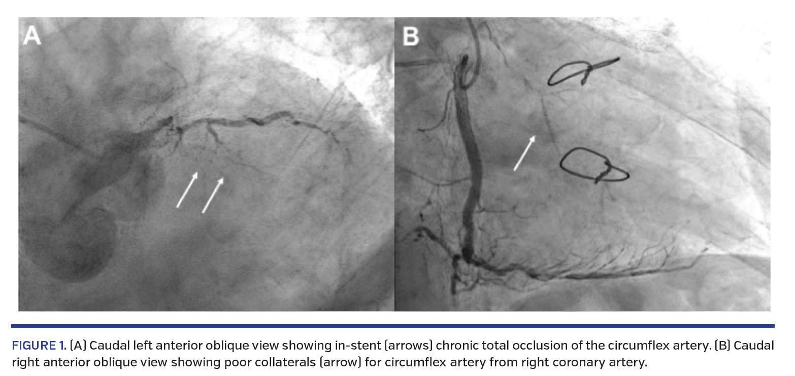 FIGURE 1. (A) Caudal left anterior oblique view showing in-stent (arrows) chronic total occlusion of the circumflex artery. (B) Caudal right anterior oblique view showing poor collaterals (arrow) for circumflex artery from right coronary artery.