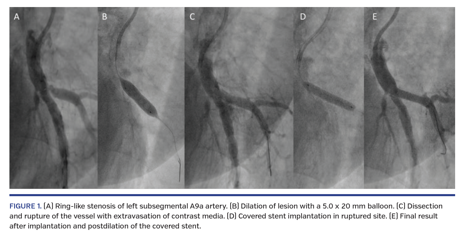 FIGURE 1. (A) Ring-like stenosis of left subsegmental A9a artery. (B) Dilation of lesion with a 5.0 x 20 mm balloon. (C) Dissection and rupture of the vessel with extravasation of contrast media. (D) Covered stent implantation in ruptured site. (E) Final result after implantation and postdilation of the covered stent.