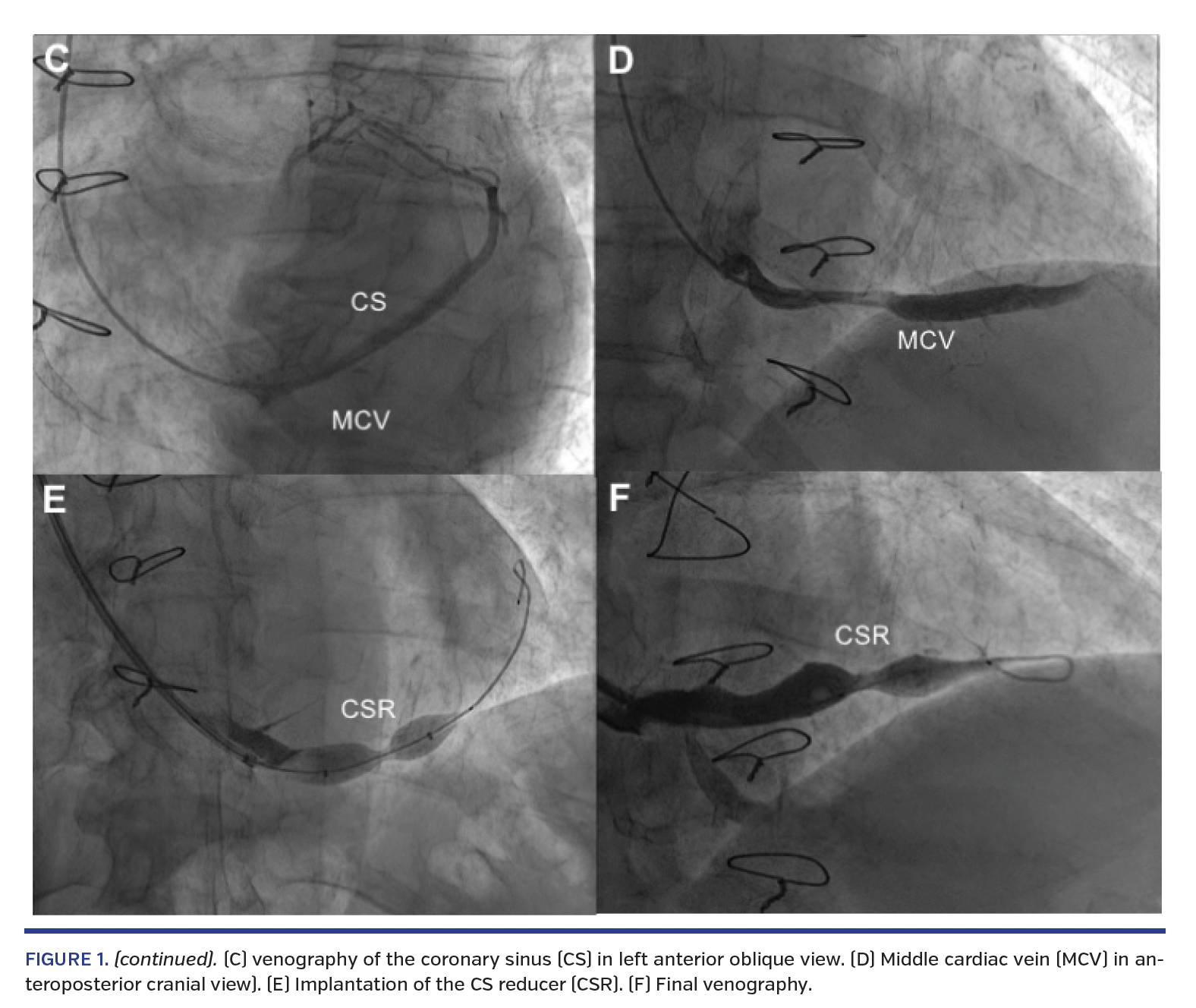 FIGURE 1. (continued). (C) venography of the coronary sinus (CS) in left anterior oblique view. (D) Middle cardiac vein (MCV) in anteroposterior cranial view). (E) Implantation of the CS reducer (CSR). (F) Final venography.