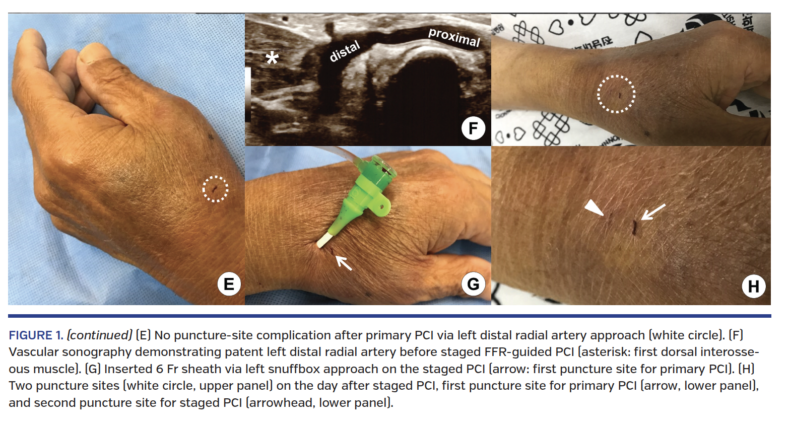 FIGURE 1. (continued) (E) No puncture-site complication after primary PCI via left distal radial artery approach (white circle). (F) Vascular sonography demonstrating patent left distal radial artery before staged FFR-guided PCI (asterisk: first dorsal interosseous muscle). (G) Inserted 6 Fr sheath via left snuffbox approach on the staged PCI (arrow: first puncture site for primary PCI). (H) Two puncture sites (white circle, upper panel) on the day after staged PCI, first puncture site for primary PCI (arrow, lower panel), and second puncture site for staged PCI (arrowhead, lower panel).