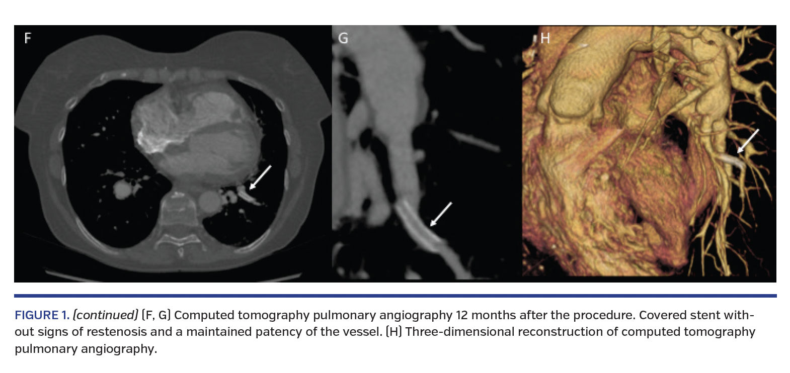 FIGURE 1. (continued) (F, G) Computed tomography pulmonary angiography 12 months after the procedure. Covered stent without signs of restenosis and a maintained patency of the vessel. (H) Three-dimensional reconstruction of computed tomography pulmonary angiography
