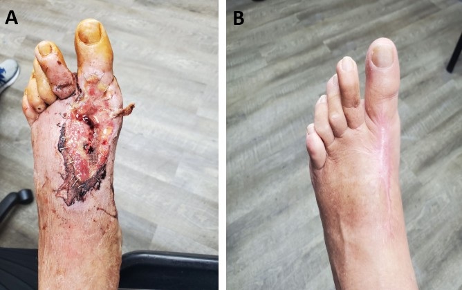 Figure 2. A) TMT arthrodesis site dehiscence B) Successfully closed wound within 12 weeks (Case 2)