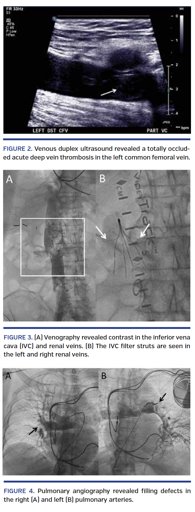 Fibrinolysis of Submassive Pulmonary Embolism
