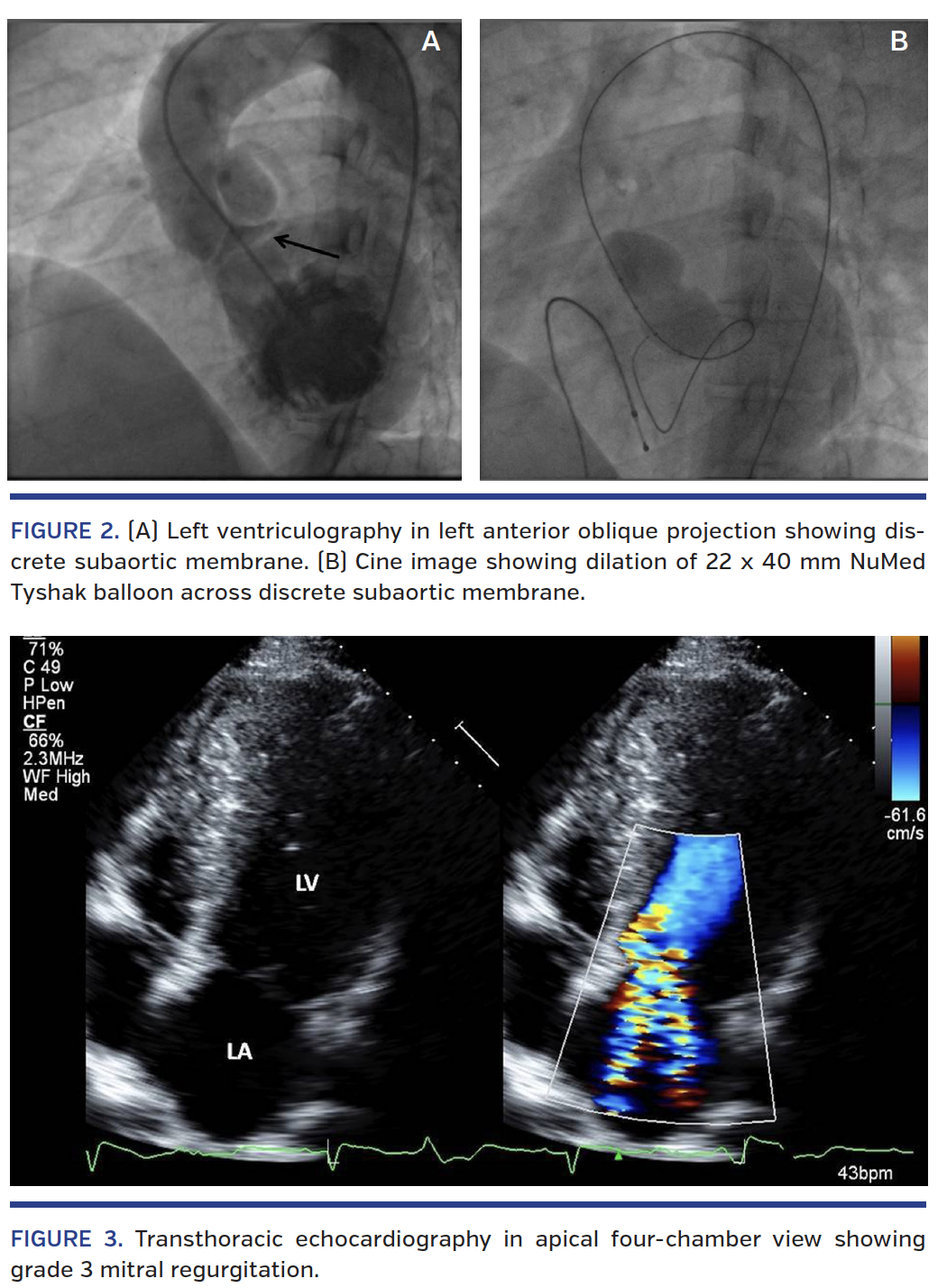  Left ventricular angiography