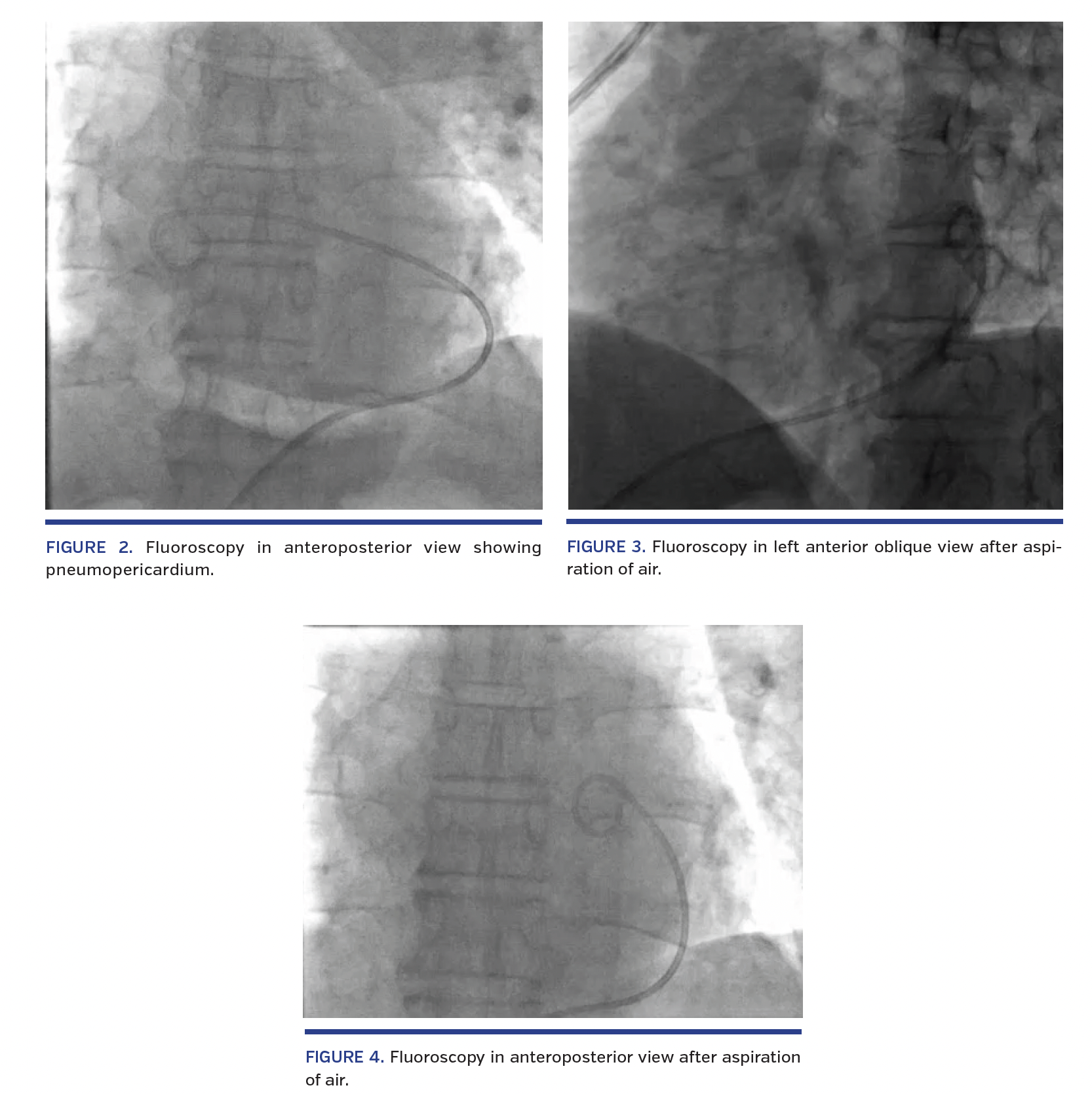 Closure of the side port