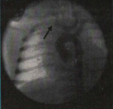 Figure 2. Aortogram showing complete occlusion of flow (arrow) to the right subclavian and carotid arteries. Note that there is a trifurcated brachiocephalic branch with good flow to the left carotid artery.