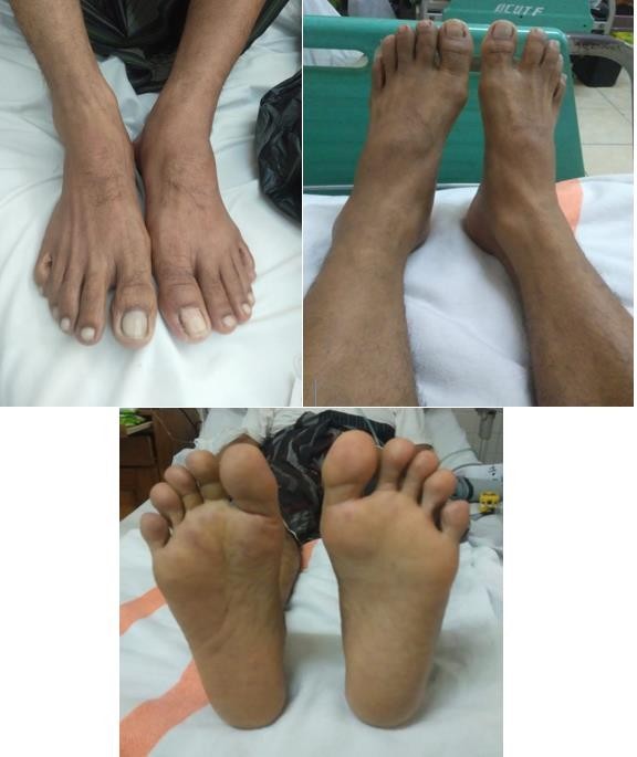 Figure 3. The front third of the foot's sole developed a purplish red rash, and the right toenail appeared slightly bluish but without necrotic tissue.