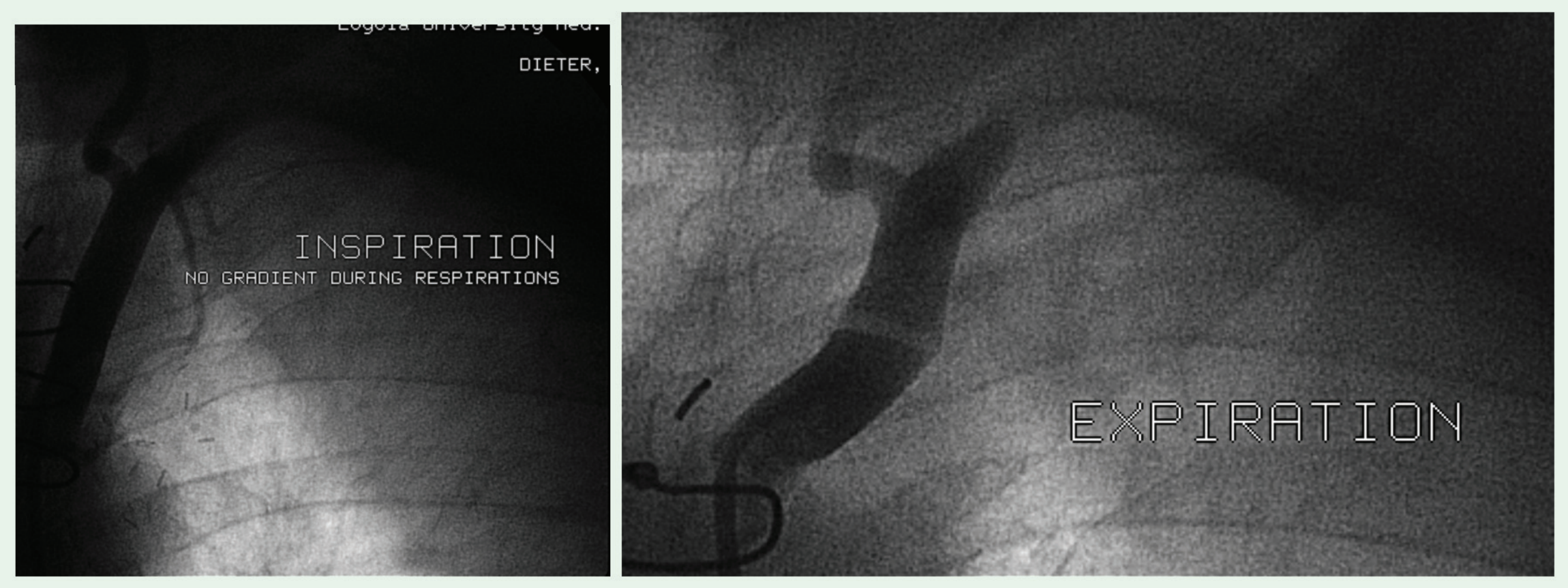 Figure 2. Inspiration (left) and Expiration (right) demonstrating dynamic proximal left subclavian artery kinking.