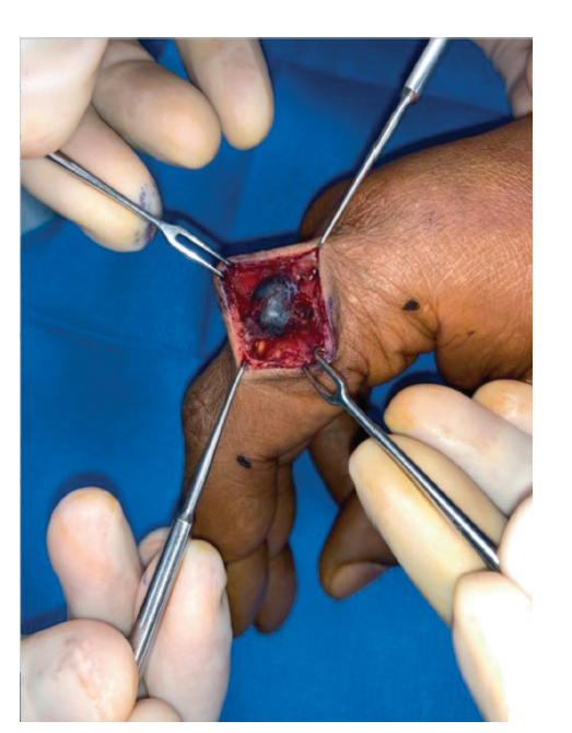 Figure 2 Mukit Masson