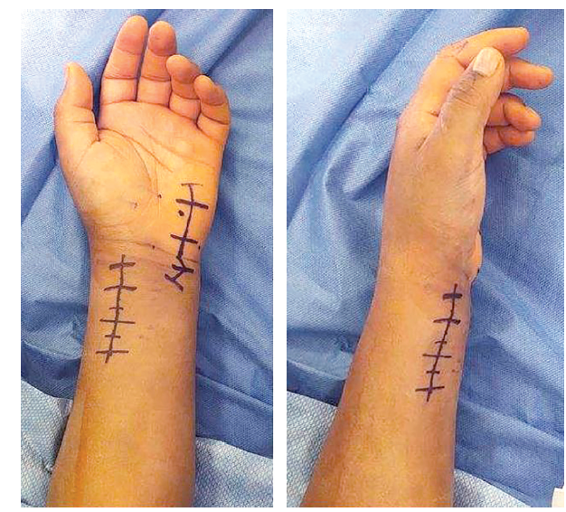 Figure 2 Siotos Distal Radius 