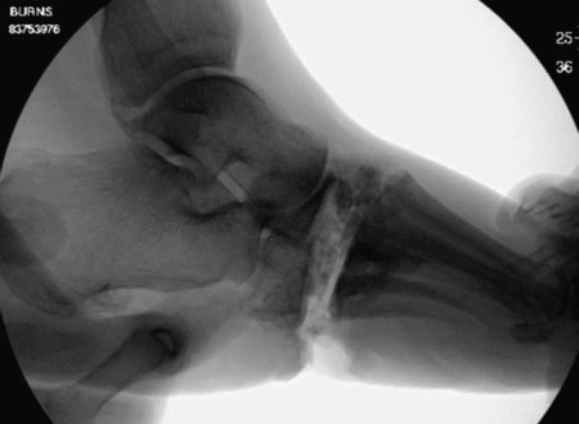 This intraoperative fluoroscopic image shows the midfoot reduction. One uses the saw to reciprocate the osteotomy once the majority of the bone wedge is removed in order to fine tune the correction.