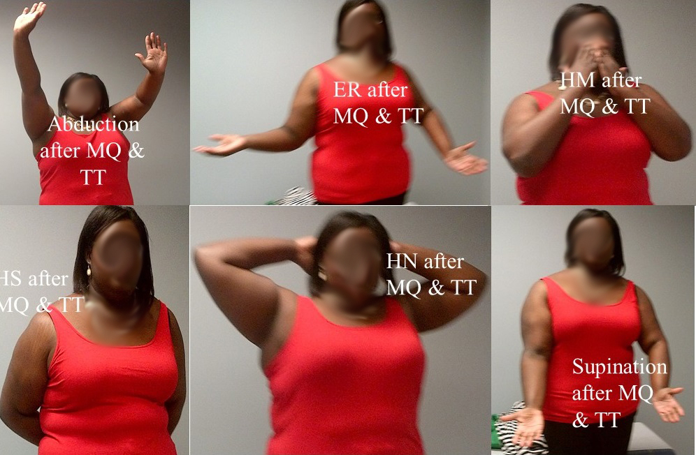 Figure 2. Modified Mallet movements of a 28-year-old woman with OBPI after Mod Quad and Triangle tilt surgeries.