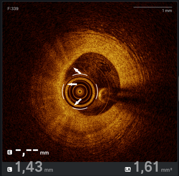 Figure 2. The active phase of vasculitis