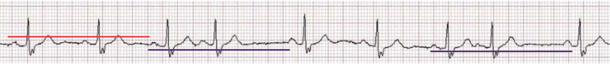 Figure 2. PAC with compensatory and non-compensatory pause.