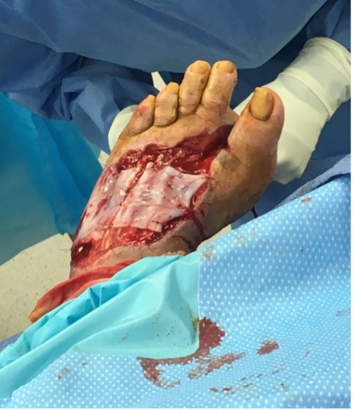 1st stravix tissue application