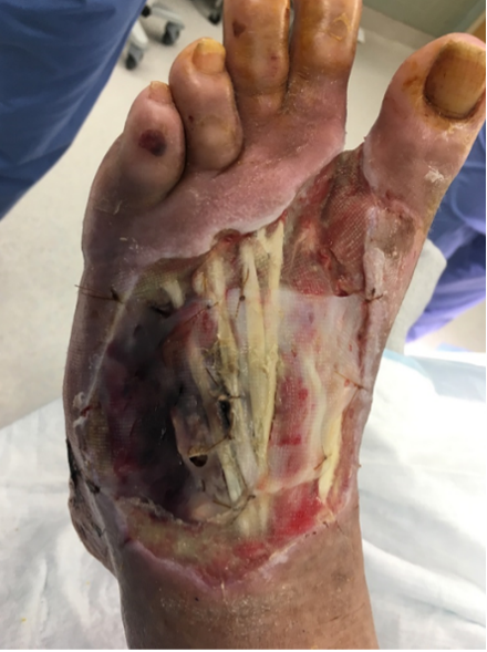 1 week after stravix tissue