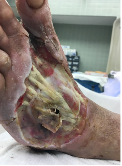 2 weeks after stravix tissue