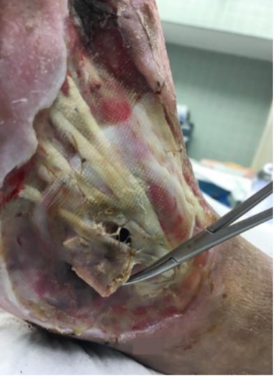 2 weeks after stravix tissue