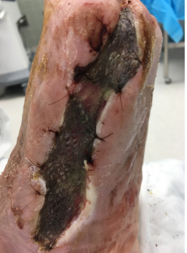 2 weeks after stravix tissue – removal of dead bone