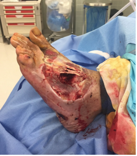 2 weeks after stravix tissue – removal of dead bone