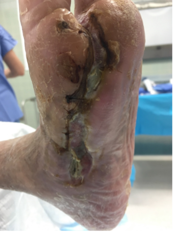Stravix tissue for plantar wound