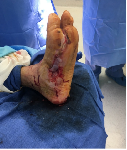 Stravix tissue for plantar wound