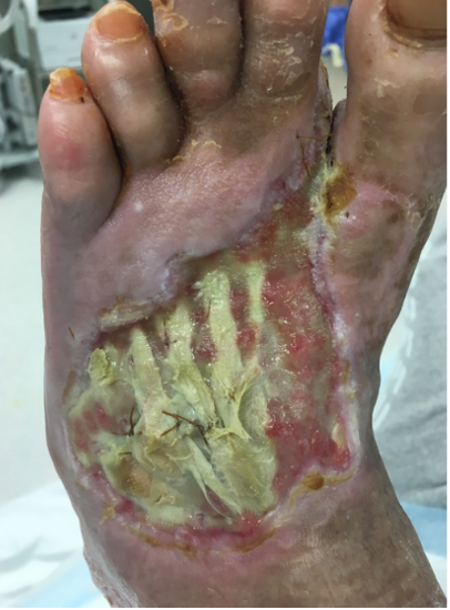 4 weeks after stravix tissue and reapplication